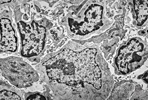 M,2y. | lymph node - lymphogranuloma - R-S cell